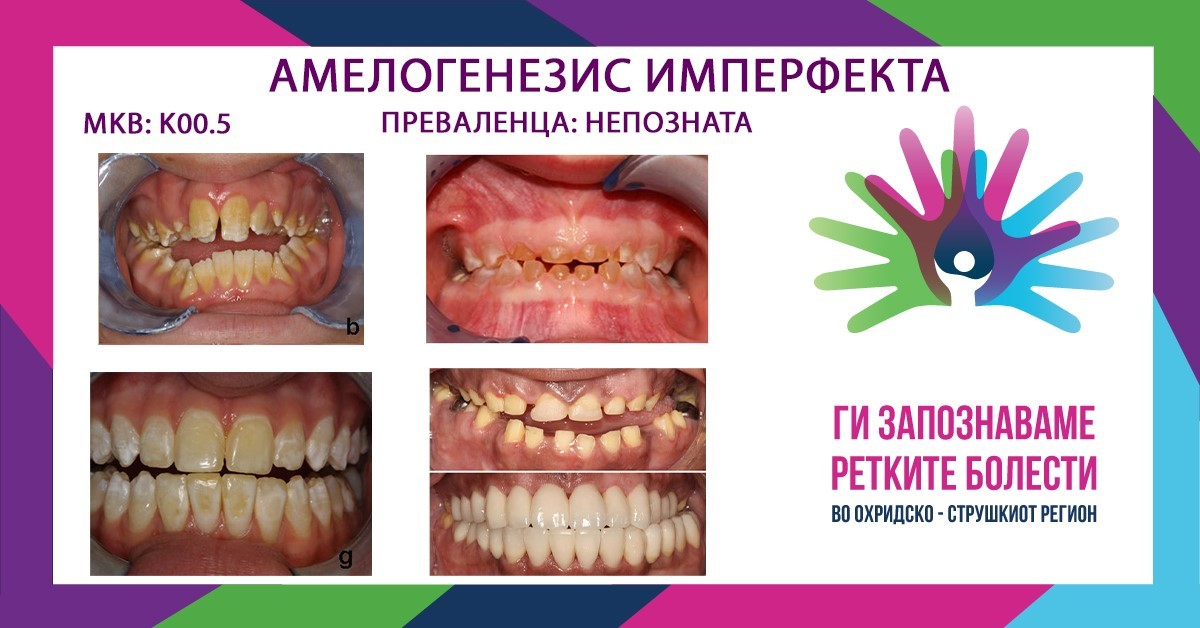 АМЕЛОГЕНЕЗИС ИМПЕРФЕКТА/ AMELOGENESIS IMPERFECTA MKБ-10 K00.5
